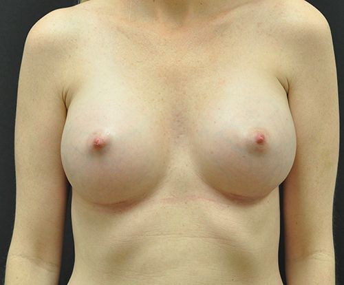 Breast Augmentation Before & After Photo Patient 122 Thumbnail