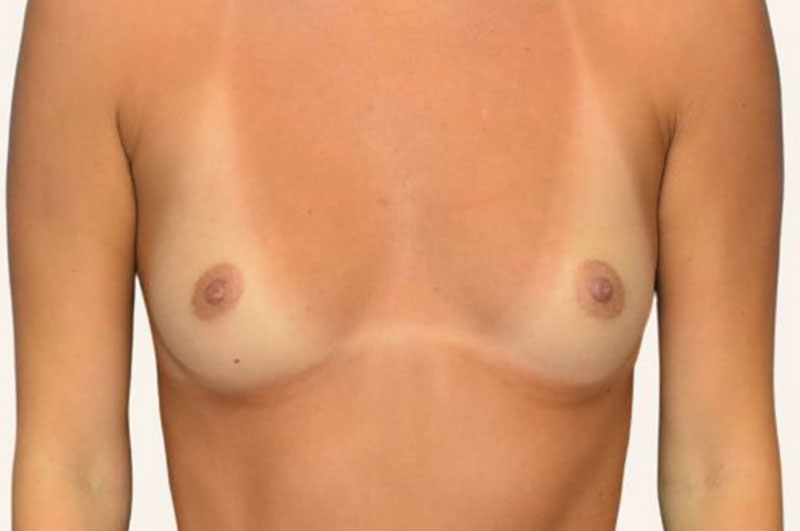 Breast Augmentation Before & After Patient 125