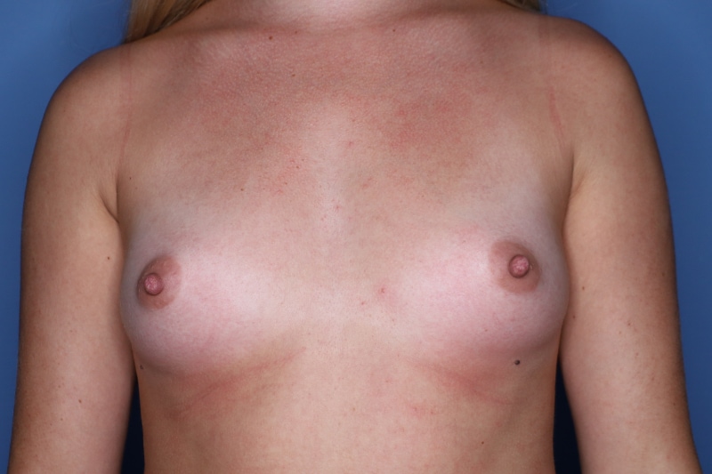 Breast Augmentation Before & After Patient 127