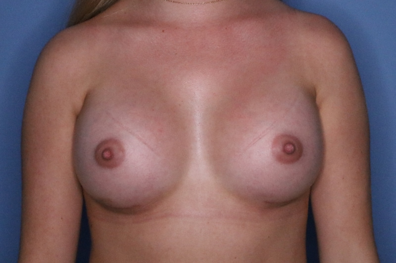 Breast Augmentation Before & After Patient 127