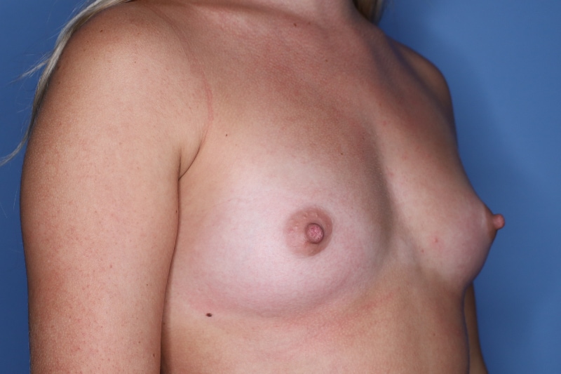 Breast Augmentation Before & After Patient 127