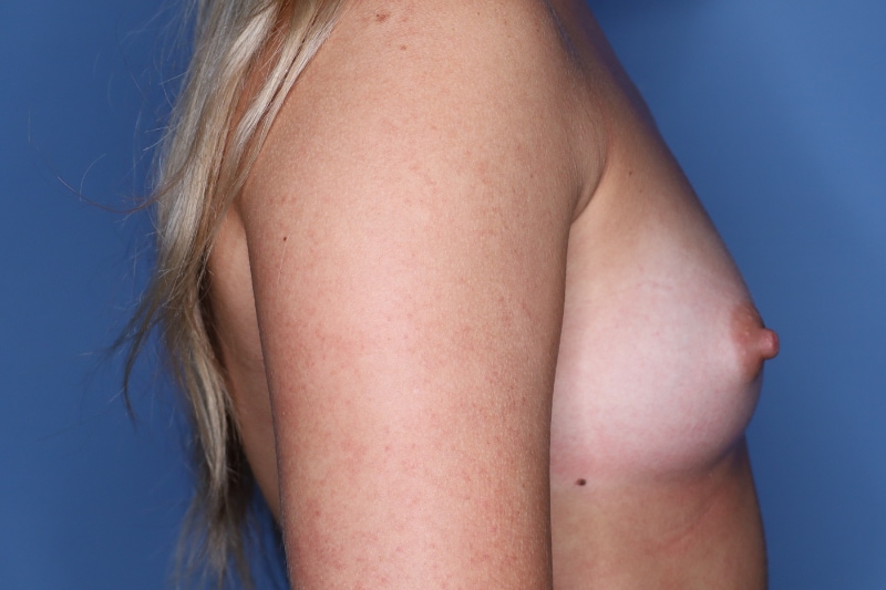 Breast Augmentation Before & After Patient 127