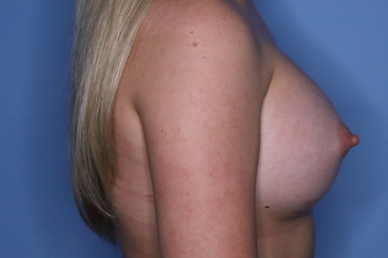 Breast Augmentation Before & After Patient 127