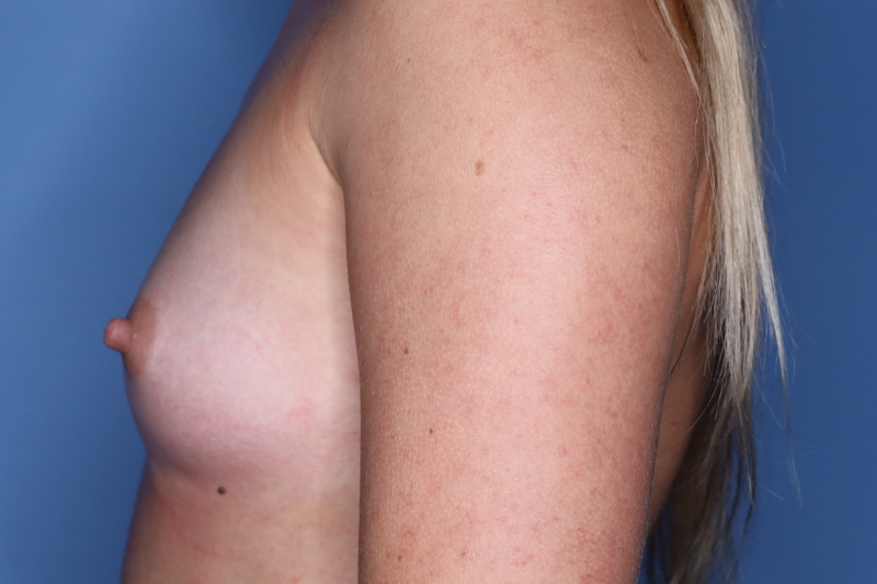 Breast Augmentation Before & After Patient 127