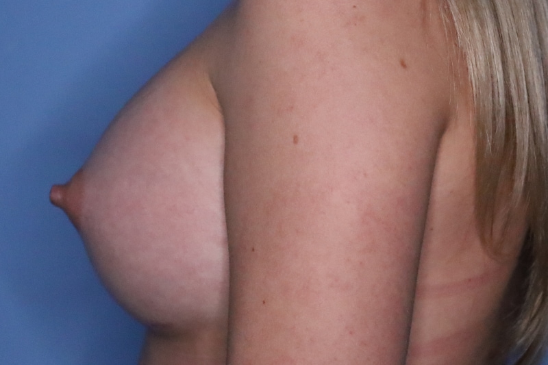 Breast Augmentation Before & After Patient 127