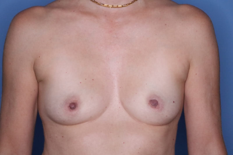 Breast Augmentation Before & After Patient 128