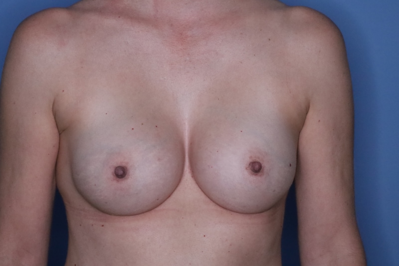 Breast Augmentation Before & After Patient 128