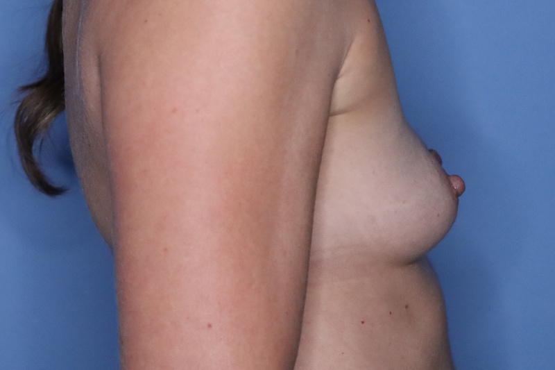 Breast Augmentation Before & After Patient 128
