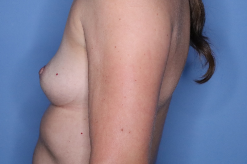 Breast Augmentation Before & After Patient 128