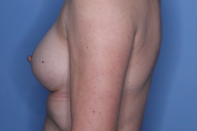 Breast Augmentation Before & After Patient 128