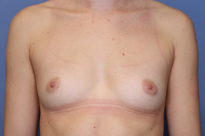 Breast Augmentation Before & After Patient 129