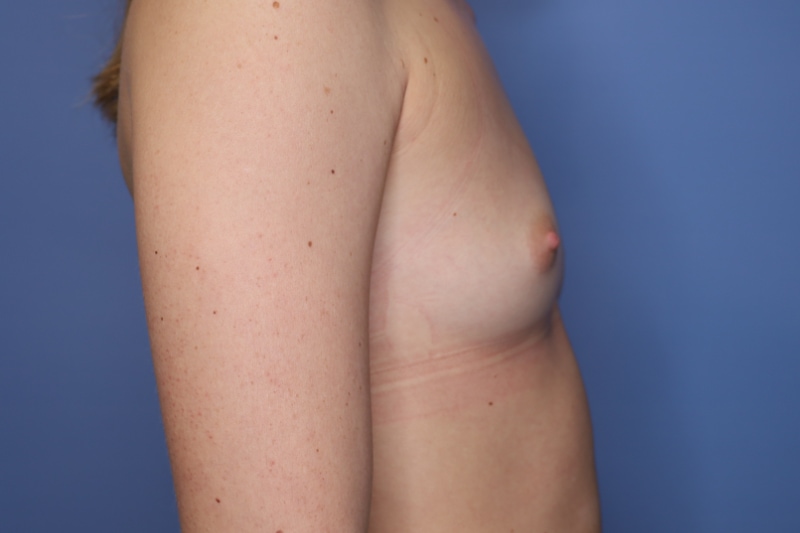 Breast Augmentation Before & After Patient 129