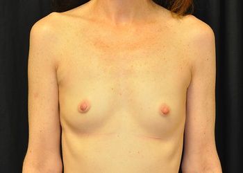 Breast Augmentation Before & After Patient 13