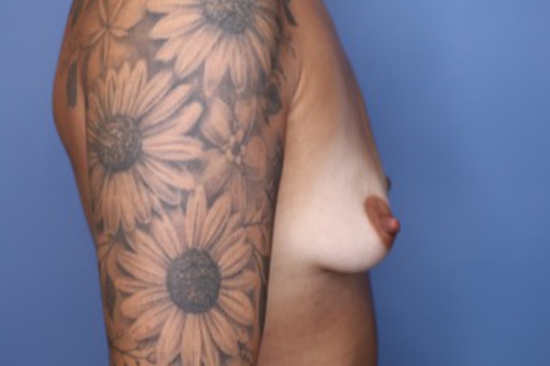Breast Augmentation Before & After Patient 130