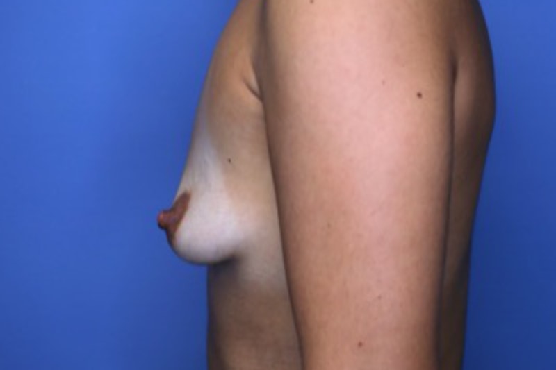 Breast Augmentation Before & After Patient 130