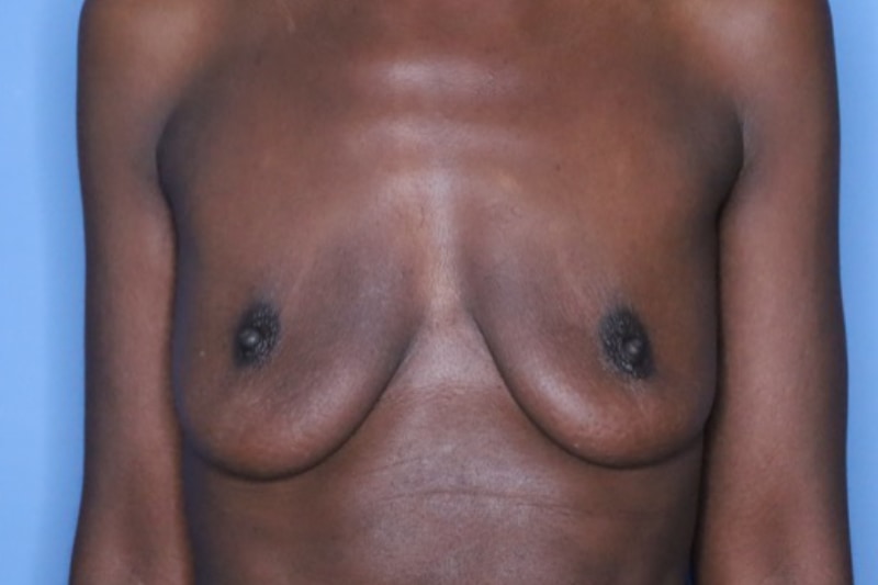Breast Augmentation Before & After Patient 131