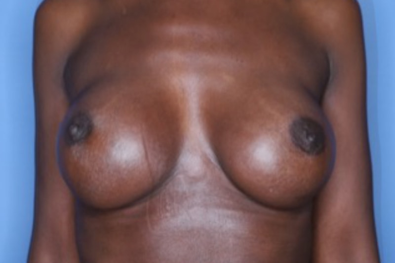 Breast Augmentation Before & After Patient 131
