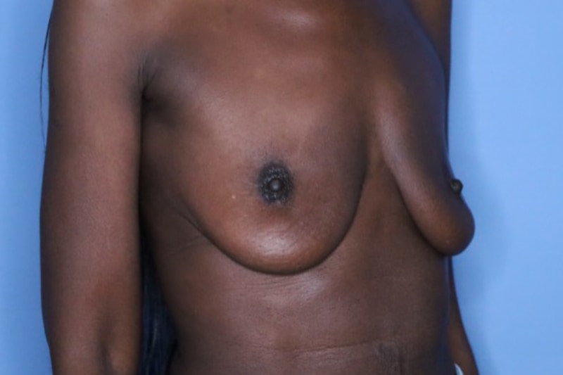 Breast Augmentation Before & After Patient 131