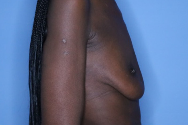 Breast Augmentation Before & After Patient 131