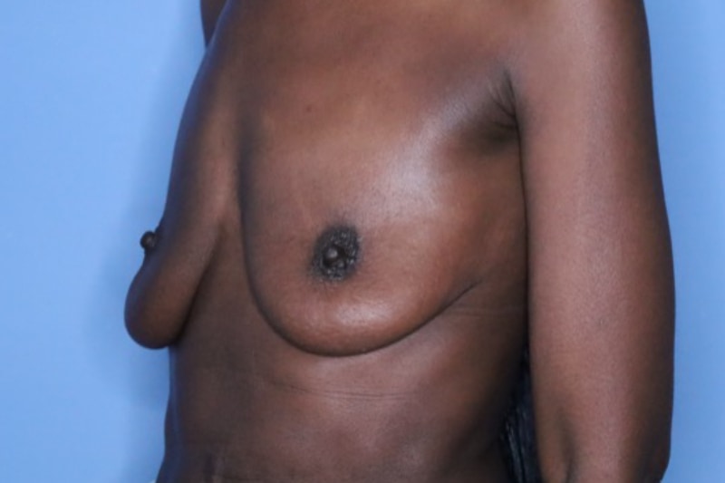 Breast Augmentation Before & After Patient 131
