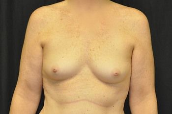 Breast Augmentation Before & After Patient 14