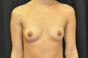 Breast Augmentation Before & After Patient 16