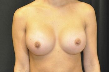 Breast Augmentation Before & After Patient 16