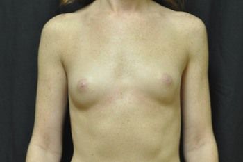 Breast Augmentation Before & After Patient 21