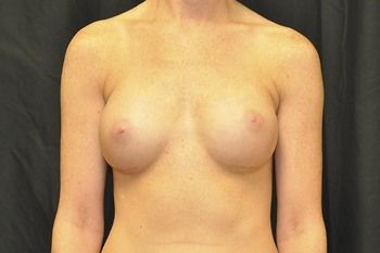 Breast Augmentation Before & After Patient 21