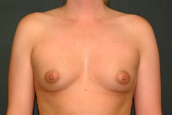 Breast Augmentation Before & After Patient 24