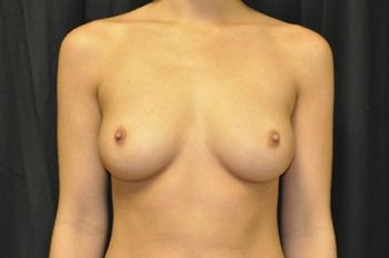 Breast Augmentation Before & After Photo Patient 25 Thumbnail
