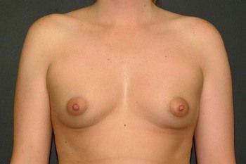 Breast Augmentation Before & After Photo Patient 26 Thumbnail