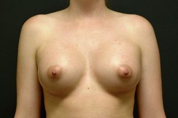 Breast Augmentation Before & After Photo Patient 26 Thumbnail