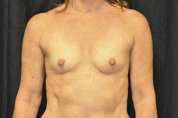 Breast Augmentation Before & After Photo Patient 30 Thumbnail