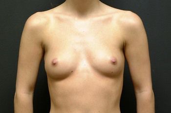 Breast Augmentation Before & After Patient 32