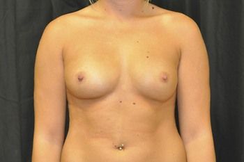 Breast Augmentation Before & After Photo Patient 35 Thumbnail