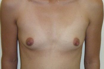 Breast Augmentation Before & After Photo Patient 38 Thumbnail