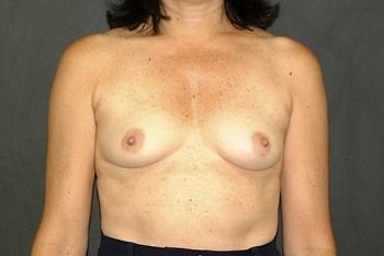 Breast Augmentation Before & After Patient 40