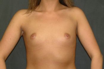 Breast Augmentation Before & After Patient 43