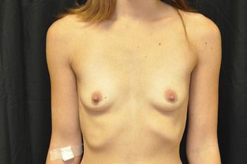 Breast Augmentation Before & After Patient 45