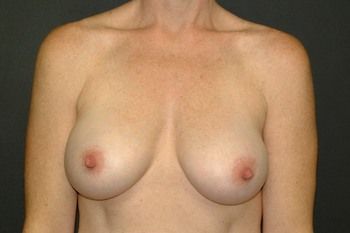 Breast Augmentation Before & After Patient 46