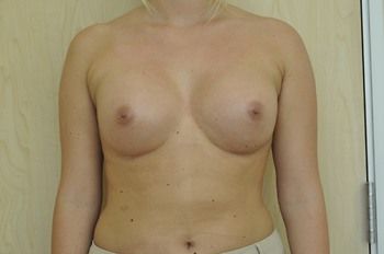Breast Augmentation Before & After Photo