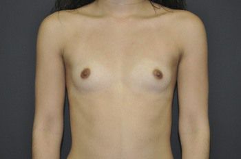 Breast Augmentation Before & After Photo Patient 49 Thumbnail