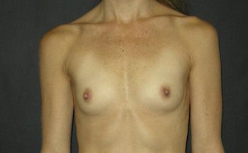 Breast Augmentation Before & After Patient 56