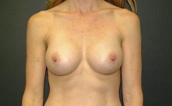 Breast Augmentation Before & After Patient 56