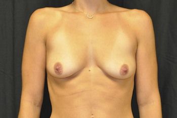 Breast Augmentation Before & After Patient 58