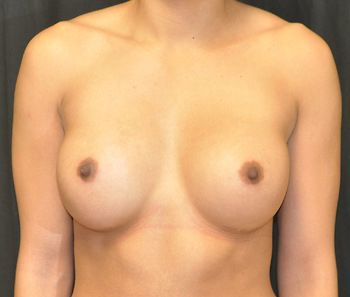 Breast Augmentation Before & After Patient 59