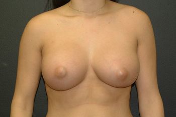 Breast Augmentation Before & After Patient 60