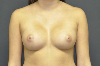 Breast Augmentation Before & After Patient 61