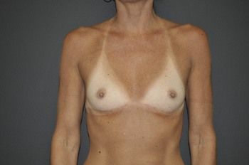 Breast Augmentation Before & After Patient 66